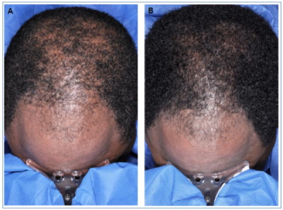 Minoxidil Vs. Male Baldness: Scientific Review