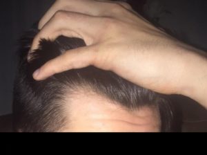 mature hairline or balding