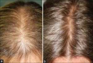 finasteride for hair loss in female